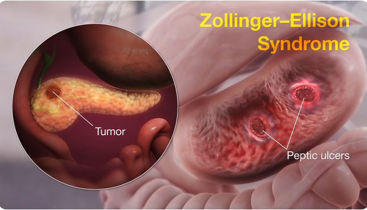 Hội chứng Zollinger - Ellison: Nguyên nhân, biểu hiện, cách điều trị và phòng bệnh- Ảnh 1.