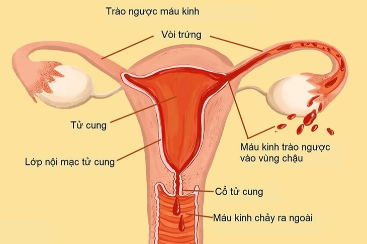 4 dấu hiệu lạc nội mạc tử cung chị em không nên bỏ qua- Ảnh 1.