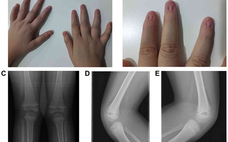 Thuốc trị hội chứng móng và xương bánh chè