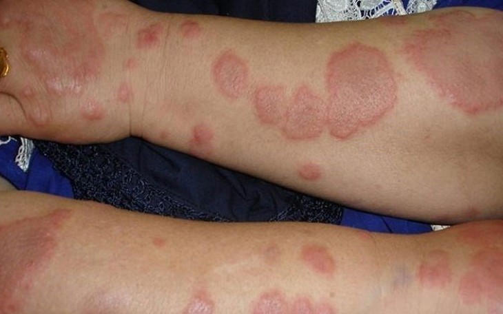 Hồng ban nút: Nguyên nhân, biểu hiện, cách điều trị và phòng bệnh