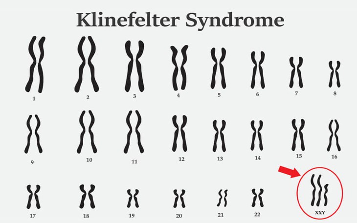 Hội chứng Klinefelter: Nguyên nhân, biểu hiện, cách điều trị và phòng bệnh