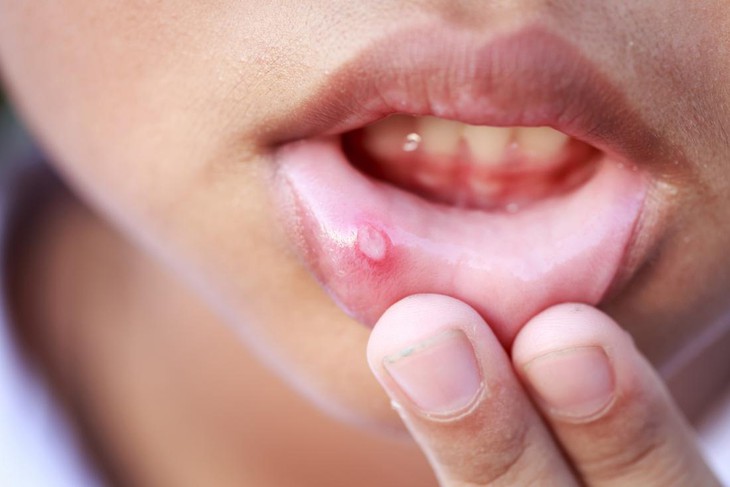 Chế độ ăn tham khảo với người mắc hội chứng Behcet- Ảnh 1. Chế độ ăn tham khảo với người mắc hội chứng Behcet- Ảnh 1.