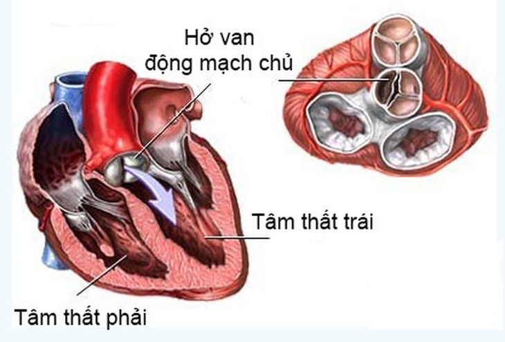 Bài tập cho người hở van động mạch chủ- Ảnh 1.