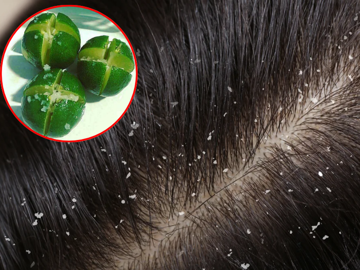 5 cách để hết gàu nhanh chóng- Ảnh 2.