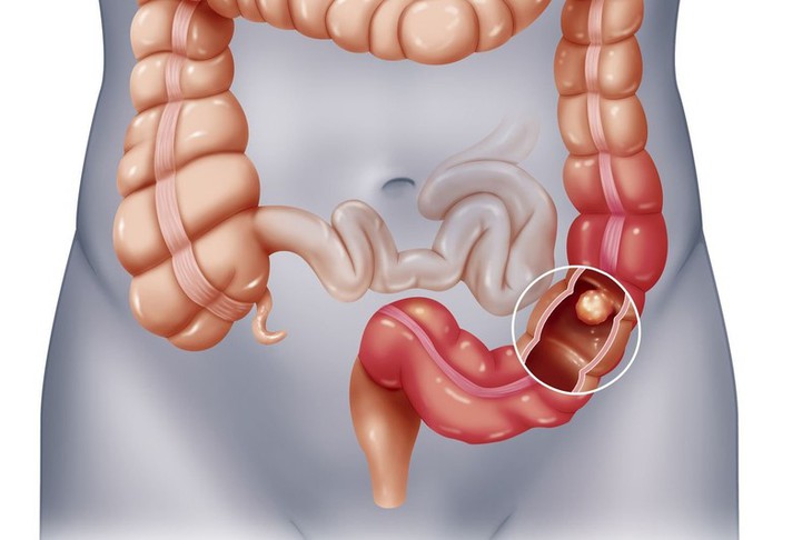 Chăm sóc dinh dưỡng cho bệnh nhân liệt ruột cần chú ý gì?- Ảnh 1.