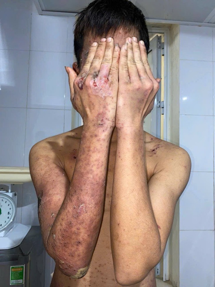 Ngược đời cả gia đình tìm bắt loài kiến có chất kịch độc về bôi chữa ngứa- Ảnh 4.