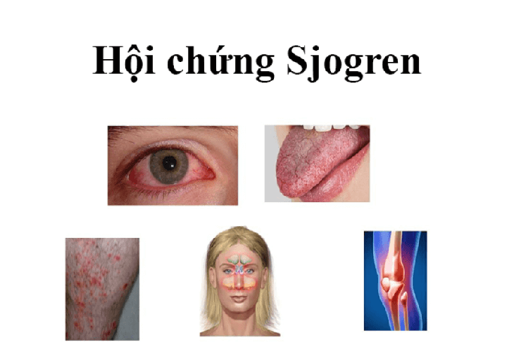 Hội chứng Sjogren: Nguyên nhân, biểu hiện, cách điều trị và phòng bệnh- Ảnh 1. Hội chứng Sjogren: Nguyên nhân, biểu hiện, cách điều trị và phòng bệnh- Ảnh 1.