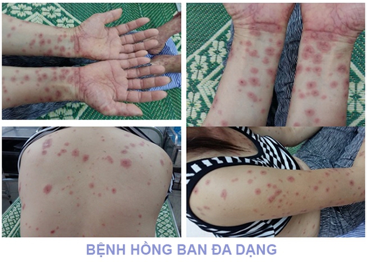 Hồng ban đa dạng: Nguyên nhân, biểu hiện, cách điều trị và phòng bệnh- Ảnh 1.