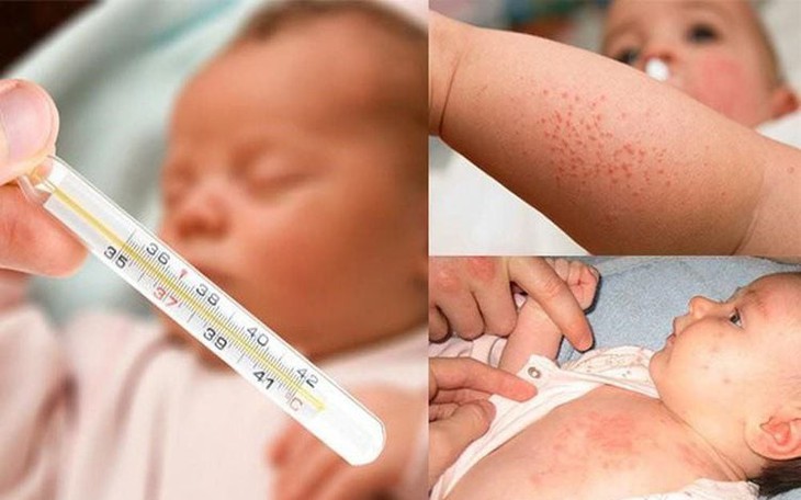 Thuốc điều trị viêm tai giữa do bệnh sởi