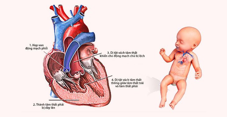 Dị tật tim bẩm sinh làm tăng nguy cơ ung thư cho cả trẻ sơ sinh và mẹ- Ảnh 1.