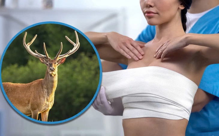 Nâng ngực bằng DNA động vật khiến một phụ nữ Trung Quốc tàn tật nặng