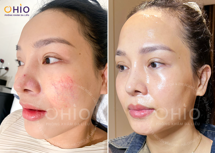 Trị giãn mao mạch uy tín tại Đà Nẵng - Chọn Phòng khám da liễu OHIO- Ảnh 3.