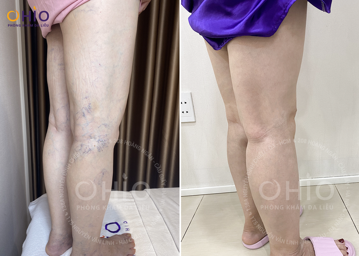 Trị giãn mao mạch uy tín tại Đà Nẵng - Chọn Phòng khám da liễu OHIO- Ảnh 4.