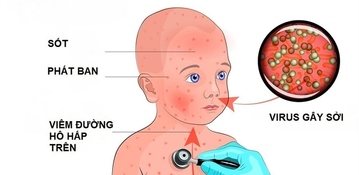 Dùng thuốc điều trị sởi và viêm não do bệnh sởi- Ảnh 1.