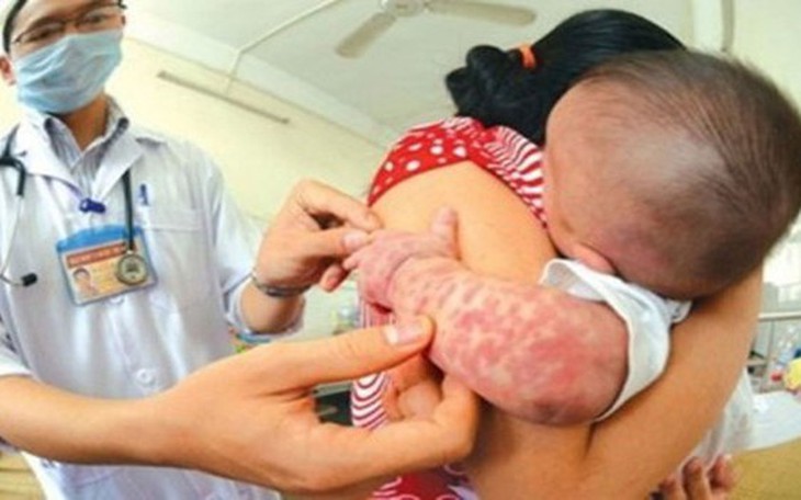 Bộ Y tế hướng dẫn mới nhất chẩn đoán, điều trị bệnh sởi
