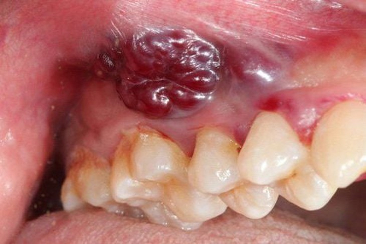 8 dấu hiệu cảnh báo ung thư khoang miệng- Ảnh 1. 8 dấu hiệu cảnh báo ung thư khoang miệng- Ảnh 1.