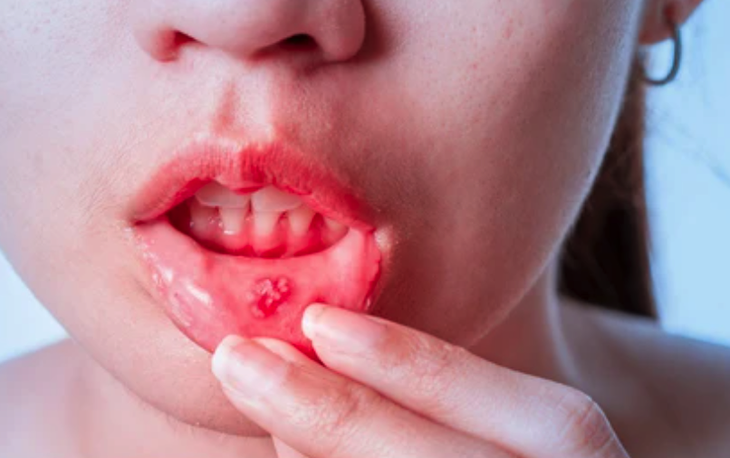 Nghiên cứu gây sốc phát hiện đồ uống phổ biến có thể gây ung thư khoang miệng- Ảnh 1. Nghiên cứu gây sốc phát hiện đồ uống phổ biến có thể gây ung thư khoang miệng- Ảnh 1.