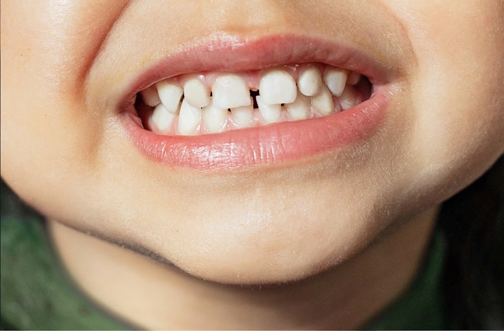 Top 3 sai lầm khi chăm sóc răng sữa ở trẻ- Ảnh 1.