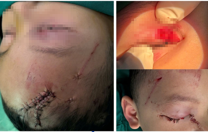 Cấp cứu trẻ bị chó cắn tổn thương nghiêm trọng vùng mặt- Ảnh 1.