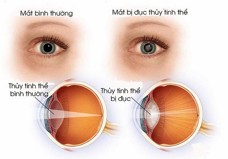Đục thủy tinh thể bẩm sinh ở trẻ cần phát hiện sớm- Ảnh 1. Đục thủy tinh thể bẩm sinh ở trẻ cần phát hiện sớm- Ảnh 1.