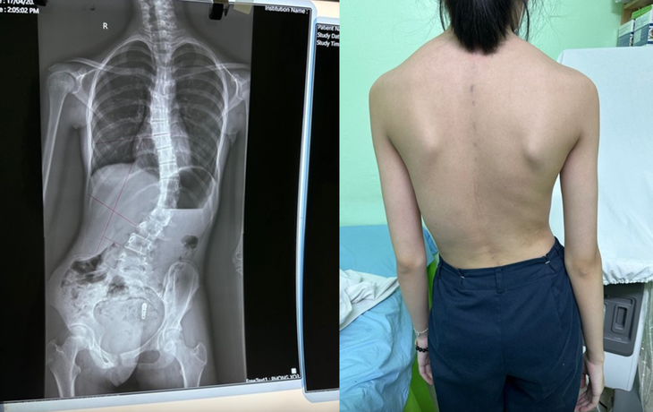 Gù cột sống: Nguyên nhân, triệu chứng, phòng ngừa và điều trị- Ảnh 2.