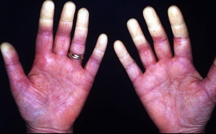 Hội chứng Raynaud: Nguyên nhân, biểu hiện, cách điều trị và phòng bệnh