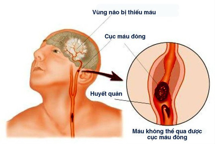 Nhồi máu não - Những điều cần biết.