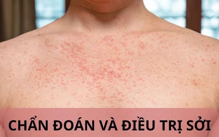 Quyết liệt triển khai vắc xin sởi trẻ từ 6 đến dưới 9 tháng tuổi trên toàn quốc