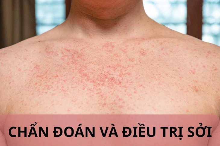 Quyết liệt triển khai vắc xin sởi trẻ từ 6 đến dưới 9 tháng tuổi trên toàn quốc- Ảnh 1. Quyết liệt triển khai vắc xin sởi trẻ từ 6 đến dưới 9 tháng tuổi trên toàn quốc- Ảnh 1.