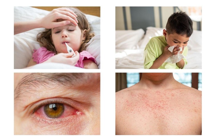 Quyết liệt triển khai vắc xin sởi trẻ từ 6 đến dưới 9 tháng tuổi trên toàn quốc- Ảnh 2. Quyết liệt triển khai vắc xin sởi trẻ từ 6 đến dưới 9 tháng tuổi trên toàn quốc- Ảnh 2.