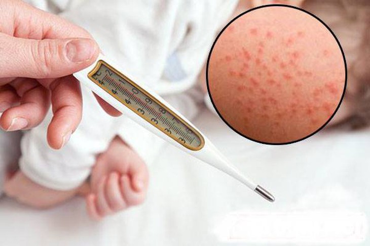 Khuyến cáo về cách bổ sung vitamin A cho trẻ mắc bệnh sởi- Ảnh 1. Khuyến cáo về cách bổ sung vitamin A cho trẻ mắc bệnh sởi- Ảnh 1.