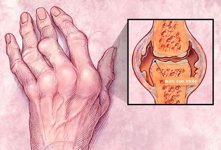 Hội chứng Felty: Nguyên nhân, biểu hiện, cách điều trị và phòng bệnh- Ảnh 1.