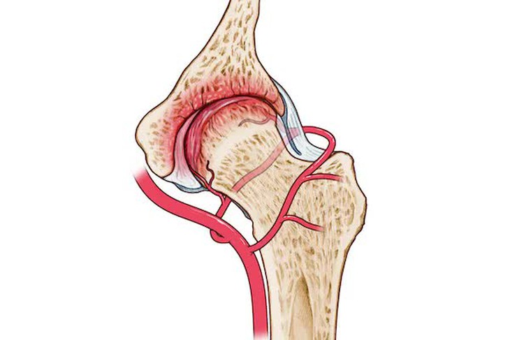 Hoại tử chỏm xương đùi: Nguyên nhân, biểu hiện, cách điều trị và phòng bệnh- Ảnh 1.