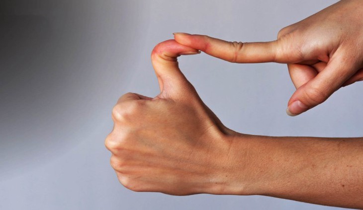 Hội chứng ehlers-danlos: Nguyên nhân, biểu hiện, cách điều trị và phòng bệnh- Ảnh 1. Hội chứng ehlers-danlos: Nguyên nhân, biểu hiện, cách điều trị và phòng bệnh- Ảnh 1.