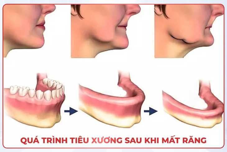 Quá trình tiêu xương diễn ra như thế nào sau khi mất răng- Ảnh 2. Quá trình tiêu xương diễn ra như thế nào sau khi mất răng- Ảnh 2.