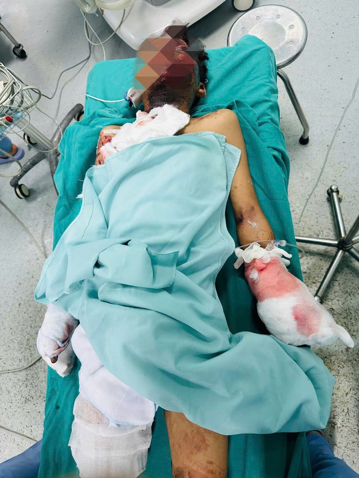 Học sinh lớp 6 bị nát bàn tay do chế tạo pháo- Ảnh 1.