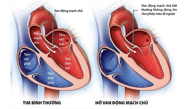Các phương pháp và dùng thuốc điều trị hở van động mạch chủ - Ảnh 1.