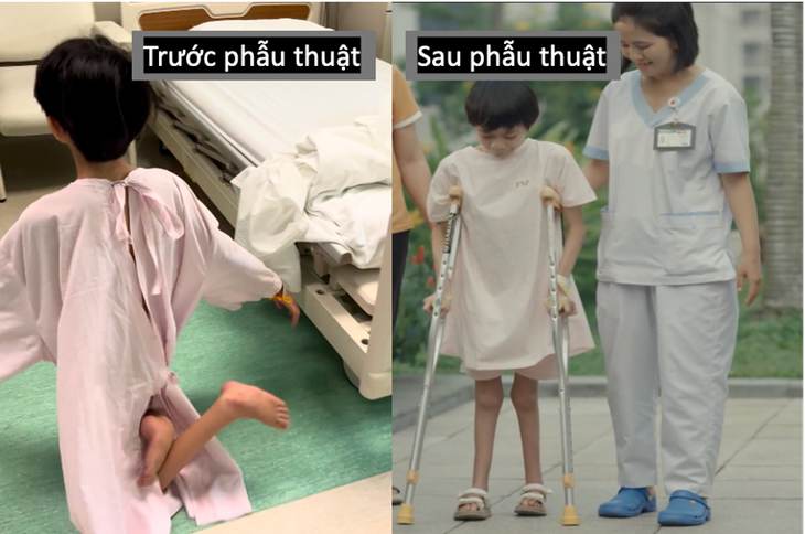 Sau 12 năm di chuyển bằng đầu gối, bé gái lần đầu được đi bằng chính đôi chân mình- Ảnh 1. Sau 12 năm di chuyển bằng đầu gối, bé gái lần đầu được đi bằng chính đôi chân mình- Ảnh 1.