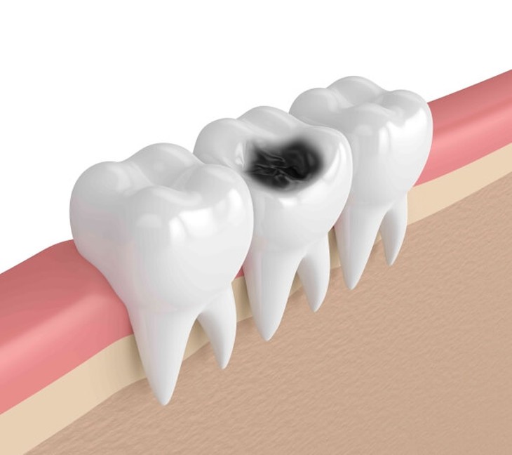 Sâu răng không được chủ quan, cách chữa thế nào?- Ảnh 1.