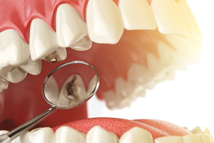 Các tổn thương này được điều trị bằng các phương pháp tái khoáng hóa mạnh để bù khoáng và các tổn thương này có thể hoàn nguyên được, không cần khoan trám và hàn răng. Các tổn thương này được điều trị bằng các phương pháp tái khoáng hóa mạnh để bù khoáng và các tổn thương này có thể hoàn nguyên được, không cần khoan trám và hàn răng.