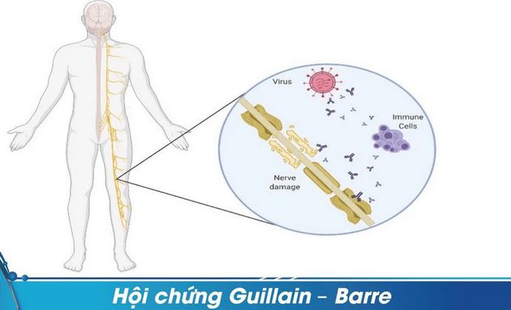 Liệt tay chân, yếu cơ do hội chứng Guillain- Barré- Ảnh 1.