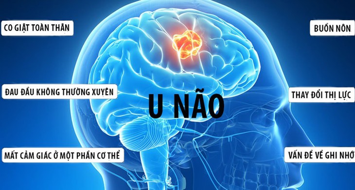 Dấu hiệu nhận biết sớm bệnh u não khiến diễn viên Quý Bình đột ngột qua đời ở tuổi 42- Ảnh 1. Dấu hiệu nhận biết sớm bệnh u não khiến diễn viên Quý Bình đột ngột qua đời ở tuổi 42- Ảnh 1.