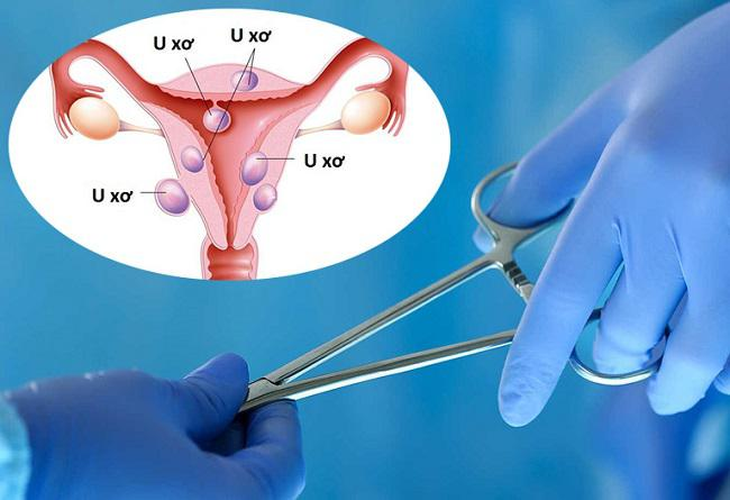 Sau mổ u xơ tử cung nên kiêng gì để nhanh hồi phục sức khỏe?- Ảnh 1. Sau mổ u xơ tử cung nên kiêng gì để nhanh hồi phục sức khỏe?- Ảnh 1.