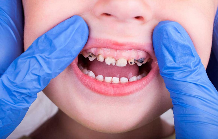 Chỉ vì một hiểu lầm về răng sữa, mẹ vô tình khiến con dễ bị sâu sún răng mà không hay- Ảnh 1.