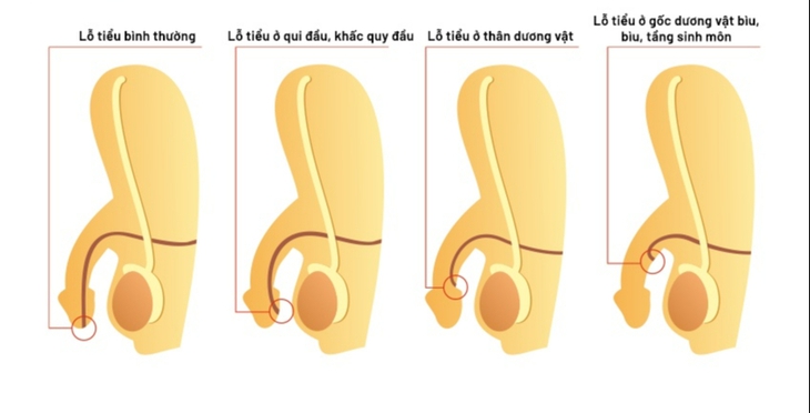 Phẫu thuật và dùng thuốc điều trị lỗ tiểu đóng thấp- Ảnh 1. Phẫu thuật và dùng thuốc điều trị lỗ tiểu đóng thấp- Ảnh 1.