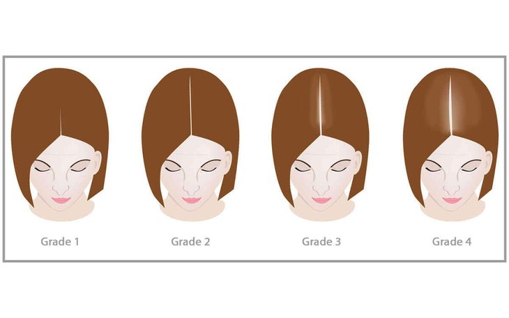 Những lý do rụng tóc thời kỳ mãn kinh và cách cải thiện