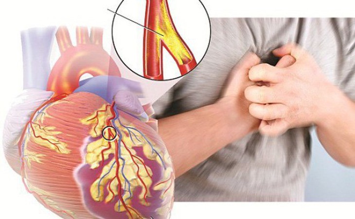 Câu hỏi thường gặp liên quan đến cơ tim phì đại- Ảnh 1. Câu hỏi thường gặp liên quan đến cơ tim phì đại- Ảnh 1.