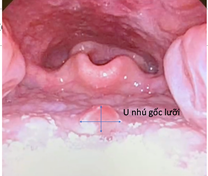 Phát hiện lạc sản niêm mạc dạ dày khi khám u gốc lưỡi ở bé 9 tuổi- Ảnh 1.