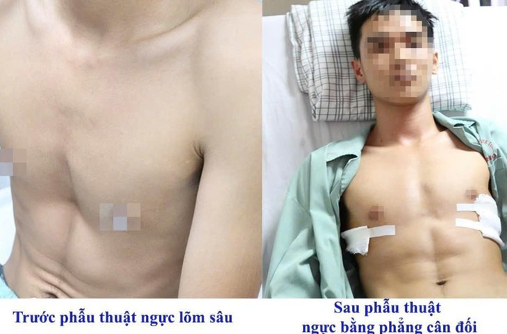 Vượt gần 2.000km từ Bà Rịa – Vũng Tàu ra Phú Thọ chữa lõm ngực bẩm sinh- Ảnh 1.