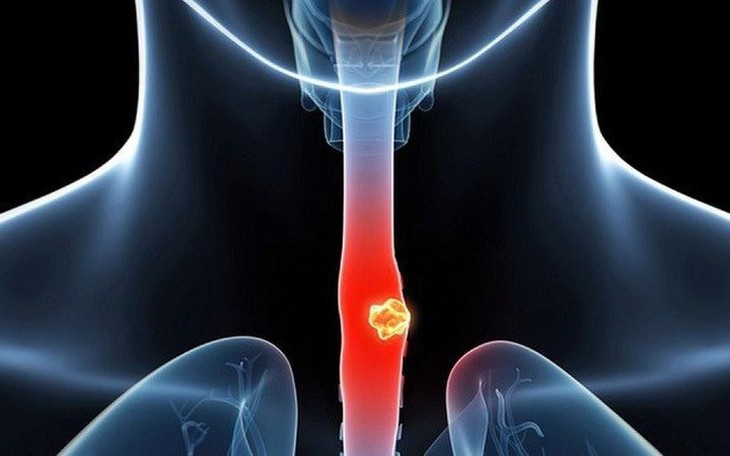 Loét thực quản: Nguyên nhân, biểu hiện, cách điều trị và phòng bệnh